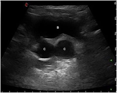 Zinner Syndrome in Pediatric Age: Issues in the Diagnosis and Treatment of a Rare Malformation Complex